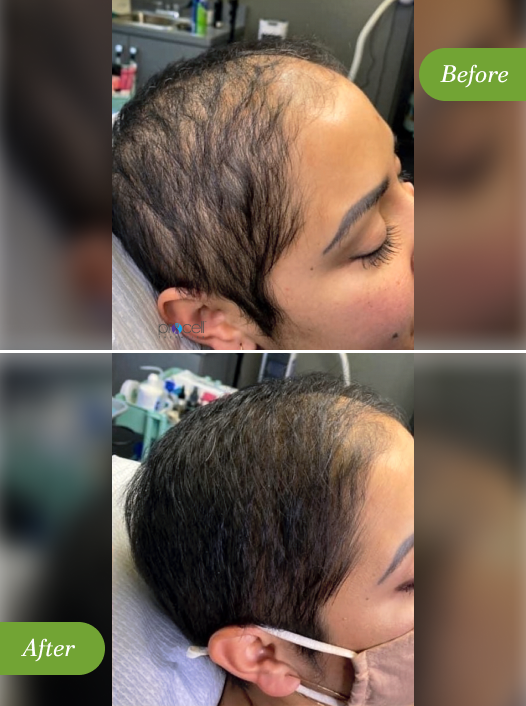 Procell Microchanneling for Hair - Are you experiencing_